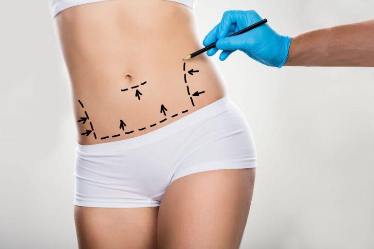 Liposuction Services In Houston5 768x512